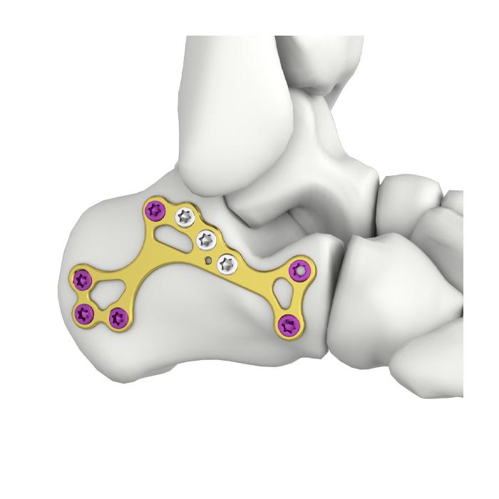 Pelat Pengunci MIS Calcaneal Itval