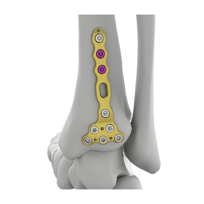 Pelat Pengunci Tibial Posterior Distal