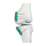 Pelat Epifisis 3,0/4,5 mm.