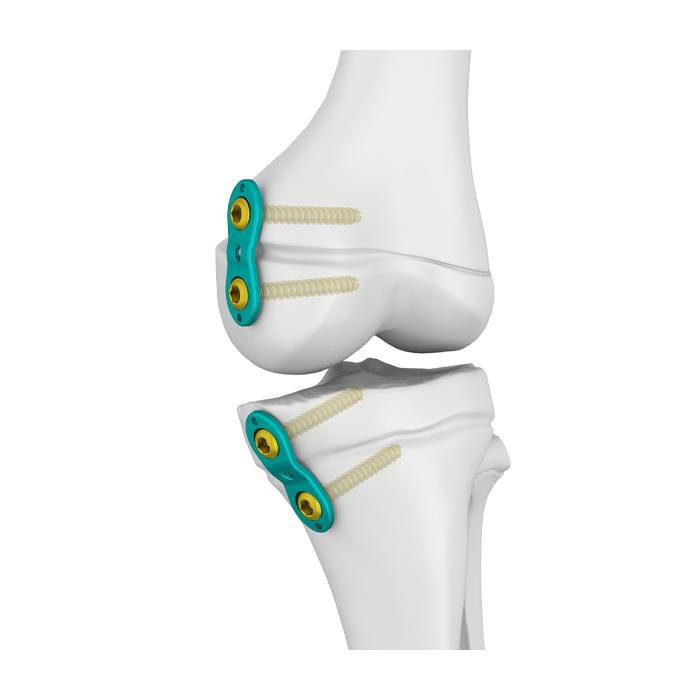 Pelat Epifisis 3,0/4,5 mm.