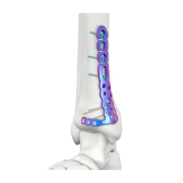 VAL Pelat Pengunci Tibia Medial Distal