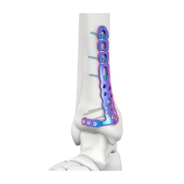 VAL Pelat Pengunci Tibia Medial Distal