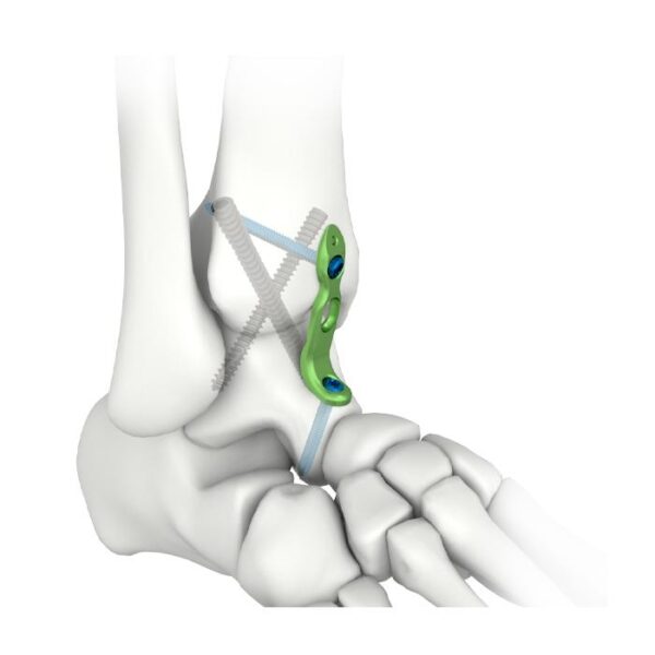Plat Pengunci Fusi Pergelangan Kaki MIS