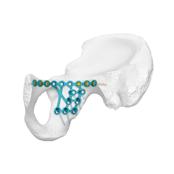 Pelat Pengunci Garis Infra-arcuate Kolom Posterior Bawah