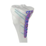 VAL Pelat Pengunci Tibia Medial Proksimal