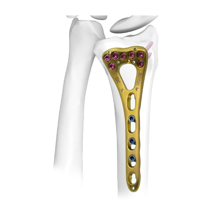 Distal Radius Locking Plate Ⅰ