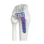 VAL Plat Pengunci DR Tibia Lateral Proksimal