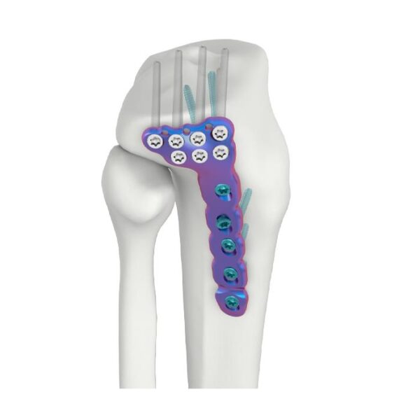 VAL Plat Pengunci DR Tibia Lateral Proksimal
