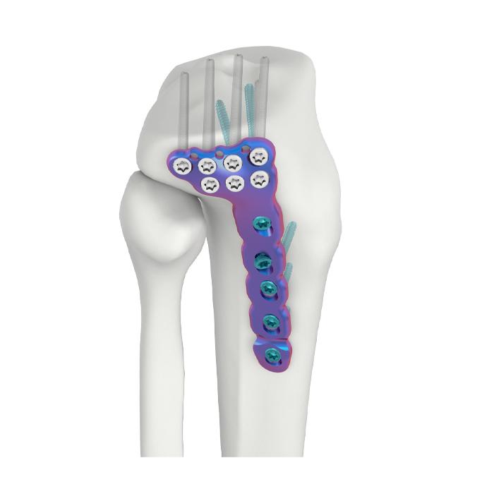 VAL Plat Pengunci DR Tibia Lateral Proksimal