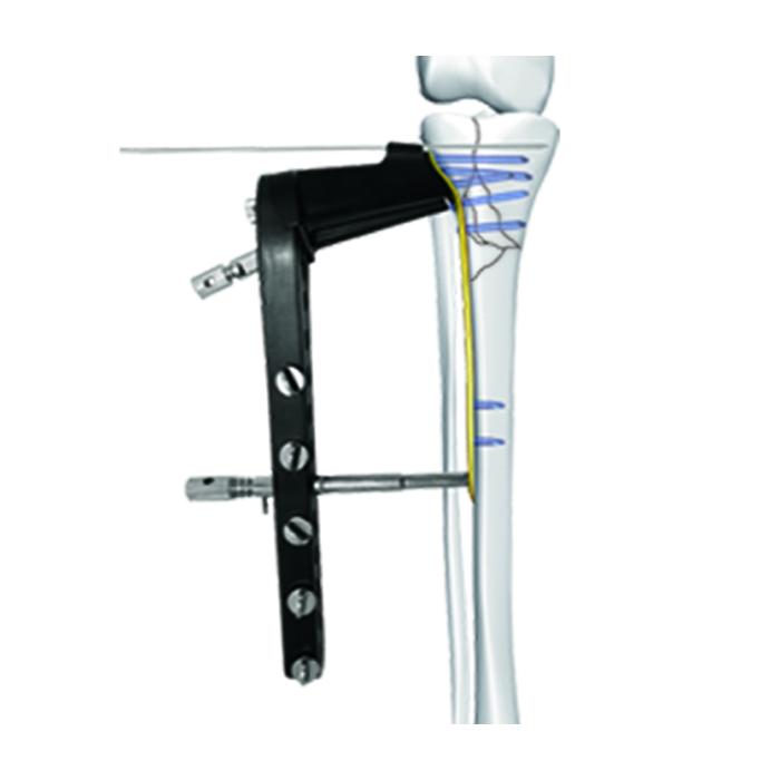 Lateral Tibial Head Buttress Locking Plate Ⅱ