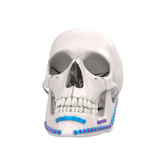 Sistem Fiksasi Mandibula