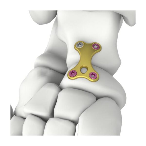 Pelat Pengunci Bentuk X