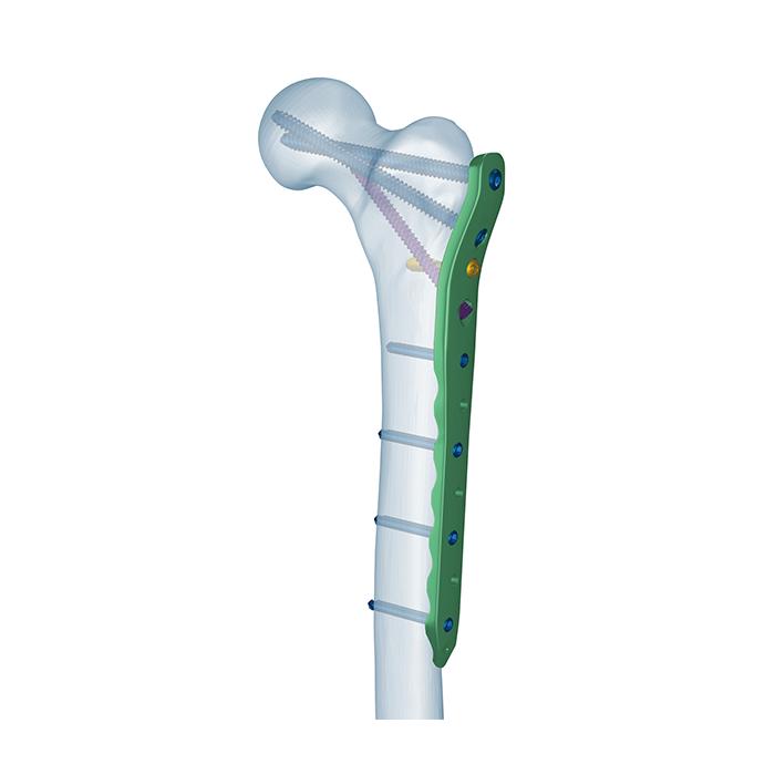 Pelat Pengunci Femur Proksimal