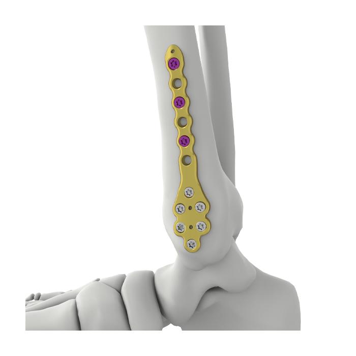 Pelat Pengunci Tibia Distal Medial