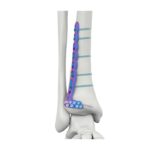 VAL Plat Pengunci Tibia Lateral Anterior Distal
