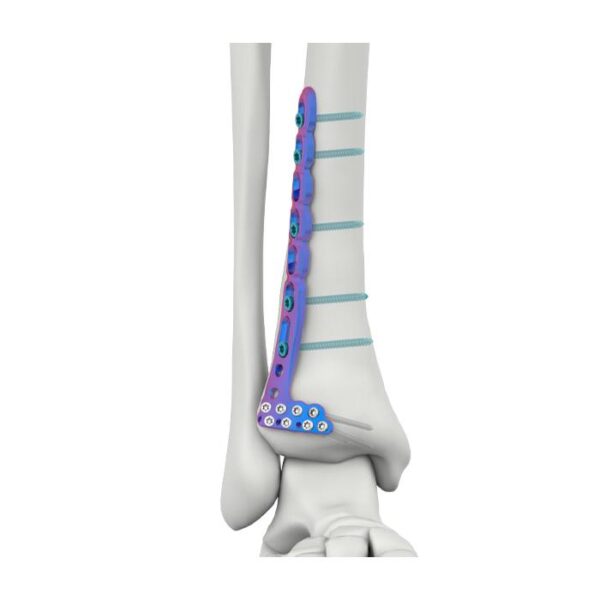 VAL Plat Pengunci Tibia Lateral Anterior Distal