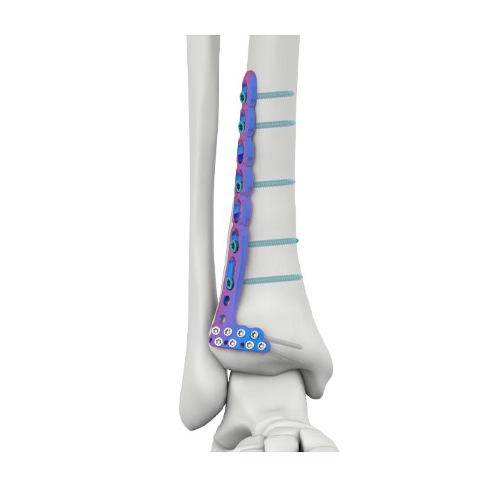VAL Plat Pengunci Tibia Lateral Anterior Distal