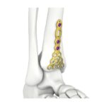 Pelat Pengunci Tibial Anterior Distal Itval