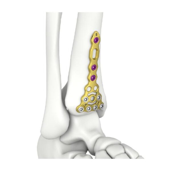 Pelat Pengunci Tibial Anterior Distal Itval