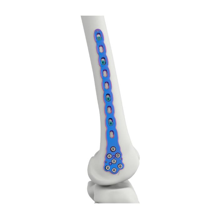 VAL Plat Pengunci Femur Distal