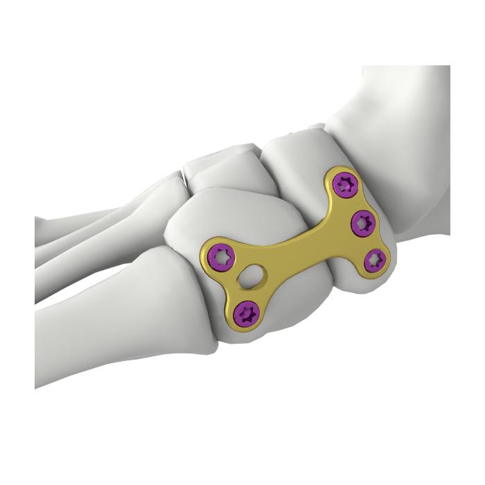 Pelat Penguncian Fusion Cuniform Navicular Itval