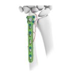 Pelat Pengunci Ulnar Distal