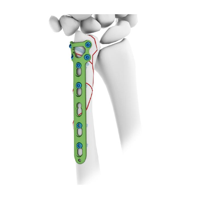 Pelat Pengunci Ulnar Distal