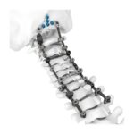 Sistem HOBBIT Serviks Posterior Spine 3.5/4.0