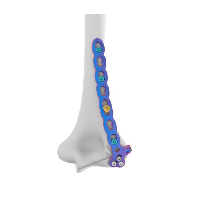VAL Pelat Pengunci Humerus Distal Lateral