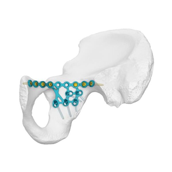 Pelat Pengunci Garis Infra-arcuate Kolom Posterior Tinggi
