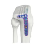 VAL Plat Pengunci SR Tibia Lateral Proksimal Rendah