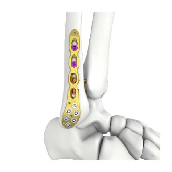 Pelat Pengunci Fibular Lateral Distal