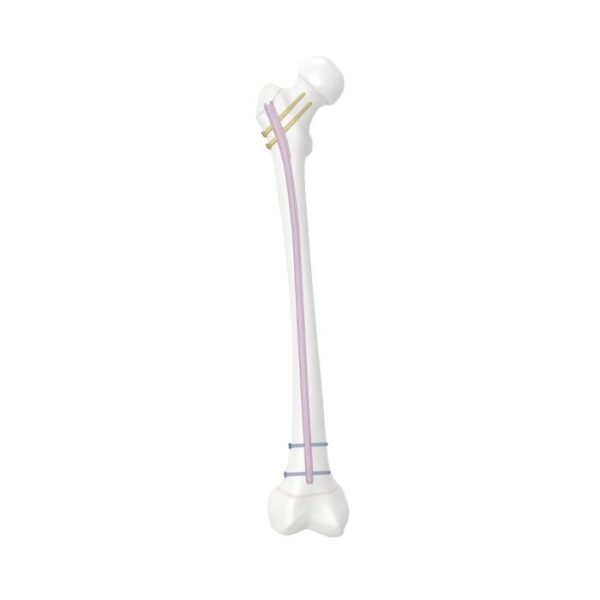 Sistem paku femoral untuk remaja